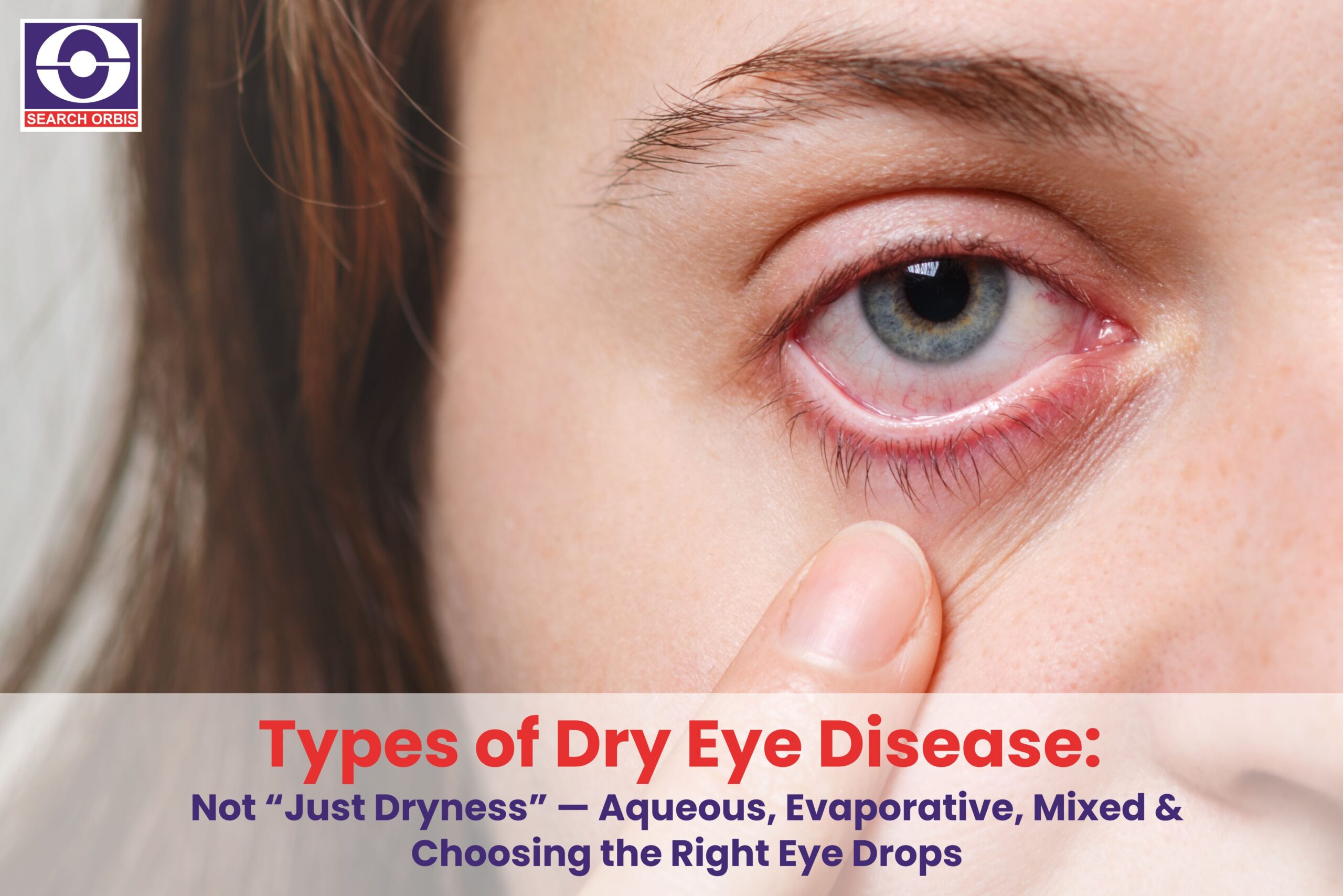 Types of Dry Eye Disease