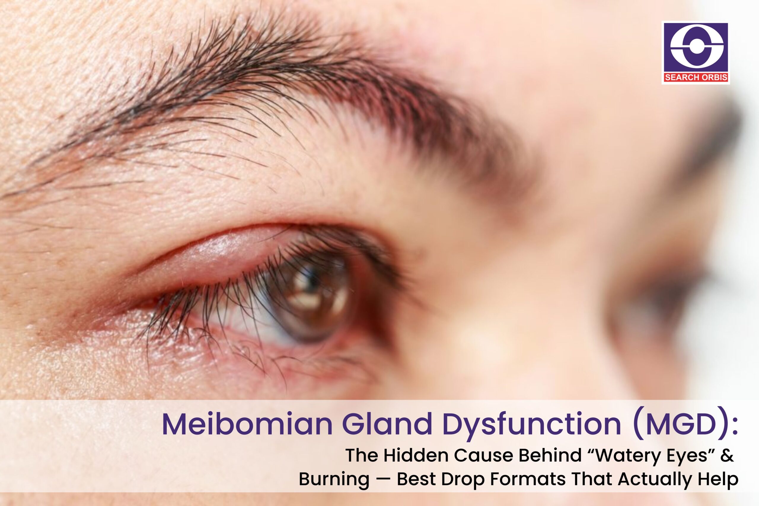 Meibomian Gland Dysfunction